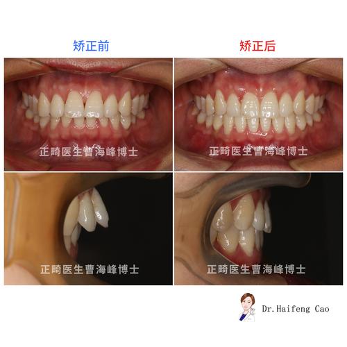 牙齿正畸为何会导致牙根外凸?原因、影响及应对方法解析-图1 牙齿正畸为何会导致牙根外凸?原因、影响及应对方法解析-图1