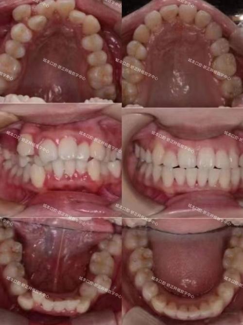 正畸牙弓轻度拥挤需要积极进行正畸干预吗？-图1