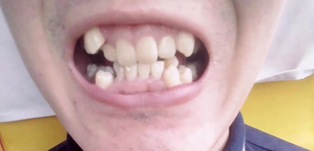 正畸牙弓轻度拥挤需要积极进行正畸干预吗？-图3