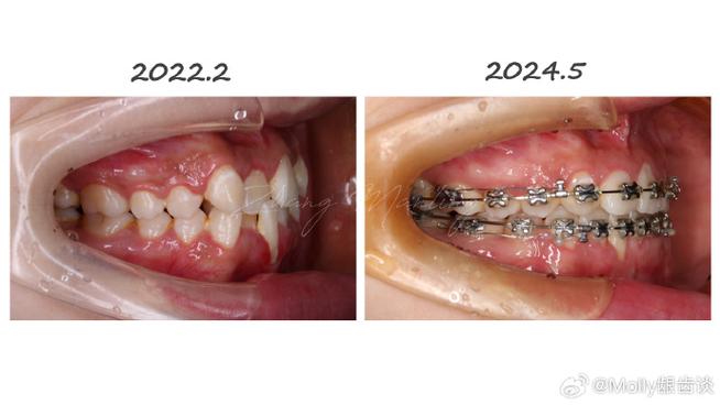 牙周健康与正畸矫正，如何相互影响与协同？-图1