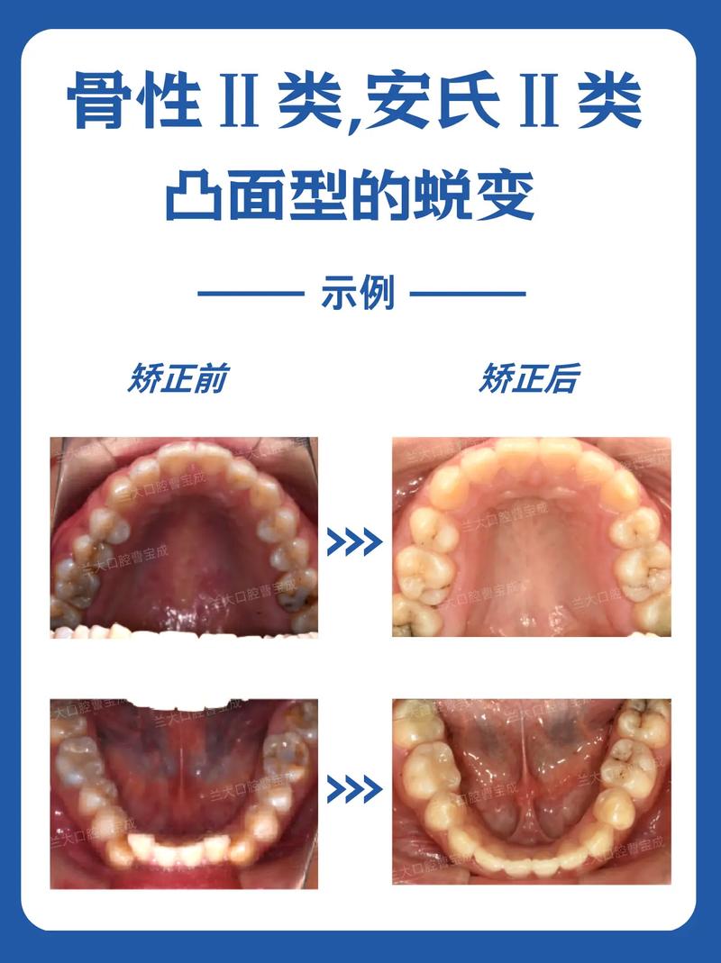 正畸凸面型的概念是什么？其正畸视角下的定义如何？-图3