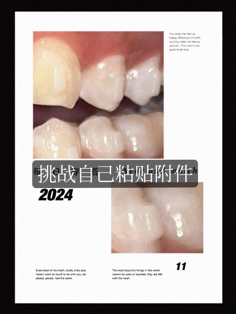 牙齿正畸牙齿附件-图2 牙齿正畸牙齿附件-图2