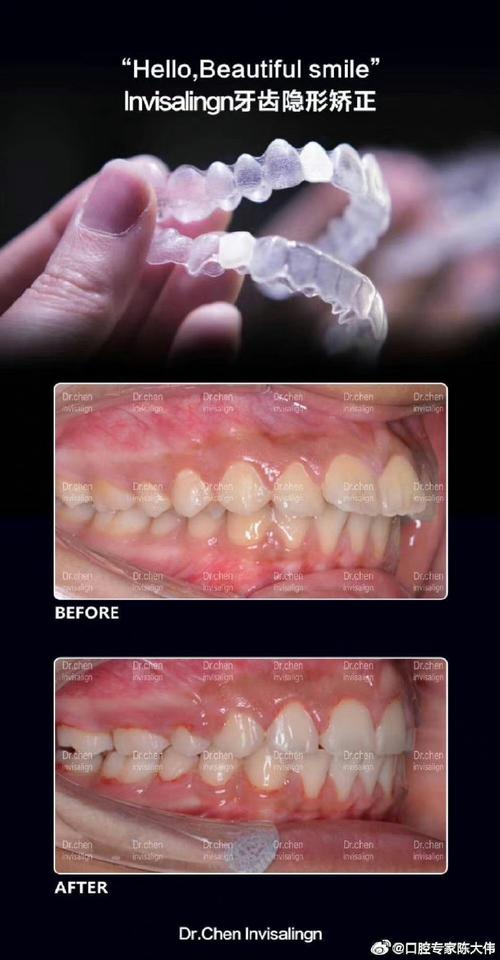 牙齿隐形正畸手术-图3 牙齿隐形正畸手术-图3