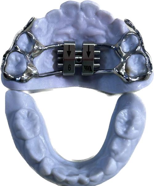 口腔正畸牵引图片能直观展示哪些牵引细节？-图2