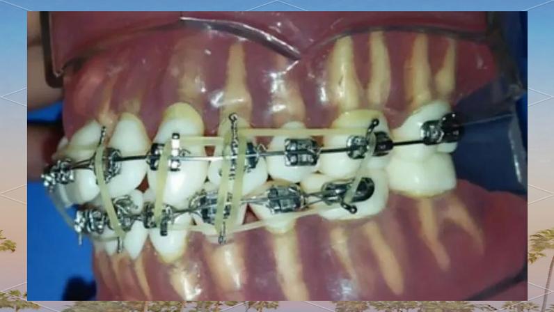 口腔正畸牵引图片能直观展示哪些牵引细节？-图3