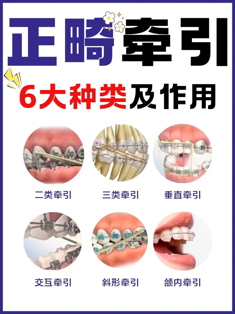 正畸中有多少技术-图3 正畸中有多少技术-图3