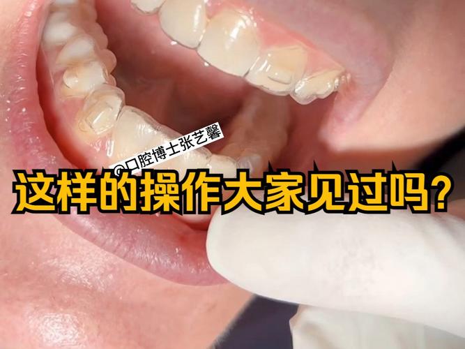 正畸隐形矫治附件对矫治效果有何关键影响?-图3 正畸隐形矫治附件对矫治效果有何关键影响?-图3
