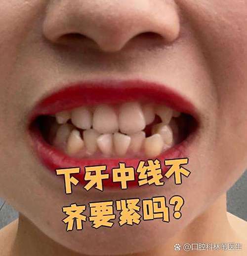 正畸之后中线偏了-图2