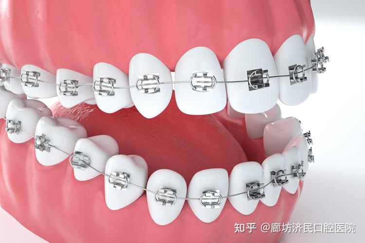 牙科正畸钢丝种类有哪些？如何挑选适合自己的？-图3