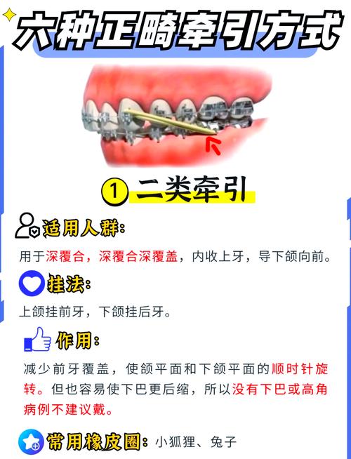 正畸牙齿左右牵引-图1 正畸牙齿左右牵引-图1