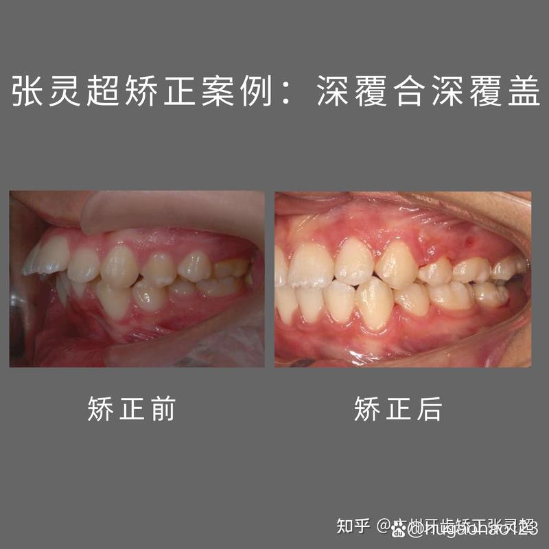 倾斜后牙正畸直立-图3