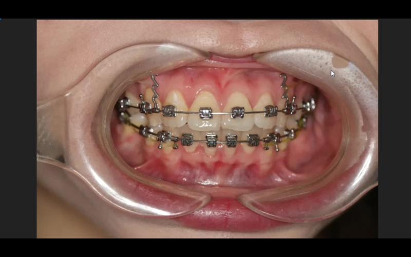 口腔正畸托槽粘贴如何实现精准定位与牢固粘贴？-图2