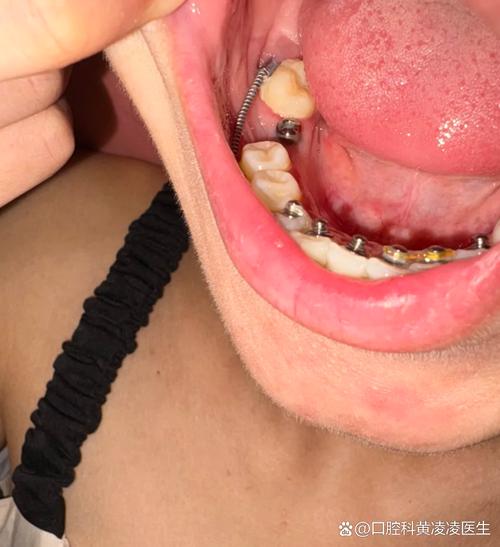 正畸牙齿后移牙床-图3