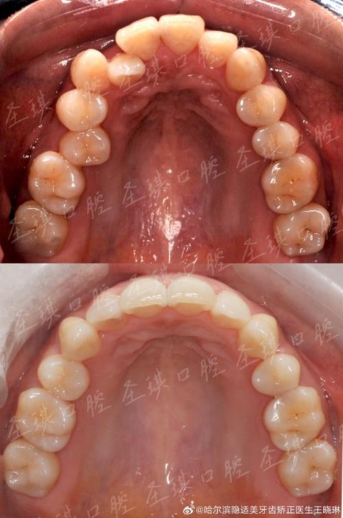 口腔正畸拍照视频-图3 口腔正畸拍照视频-图3