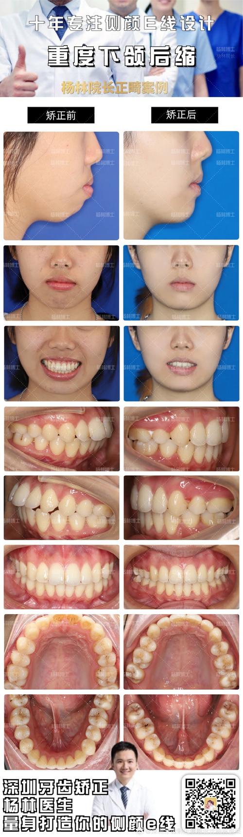 青年正畸案例，矫正周期长，效果与疼痛如何平衡？-图2