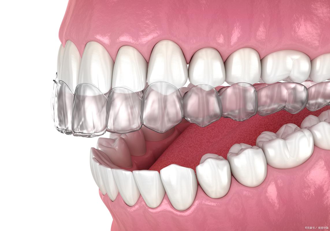 口腔正畸流程简介-图3 口腔正畸流程简介-图3