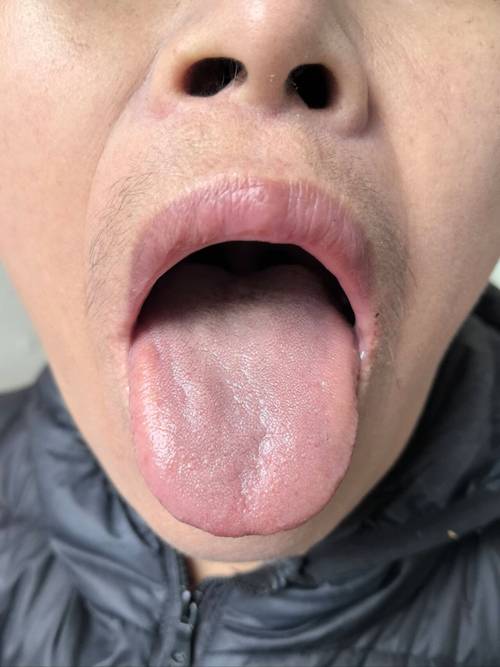 正畸带环牙痛流血是什么原因?-图1 正畸带环牙痛流血是什么原因?-图1