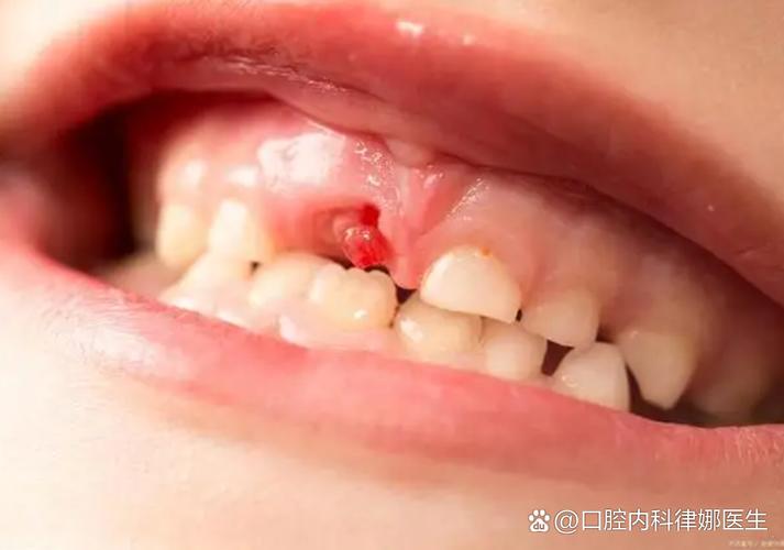 正畸带环牙痛流血是什么原因?-图2 正畸带环牙痛流血是什么原因?-图2