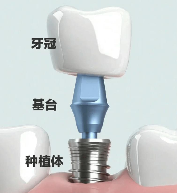牙周正畸种植，治疗顺序如何定？-图2