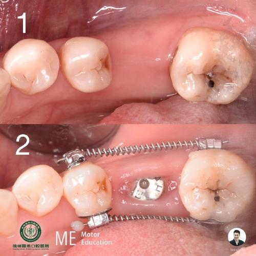 牙周正畸种植，治疗顺序如何定？-图3