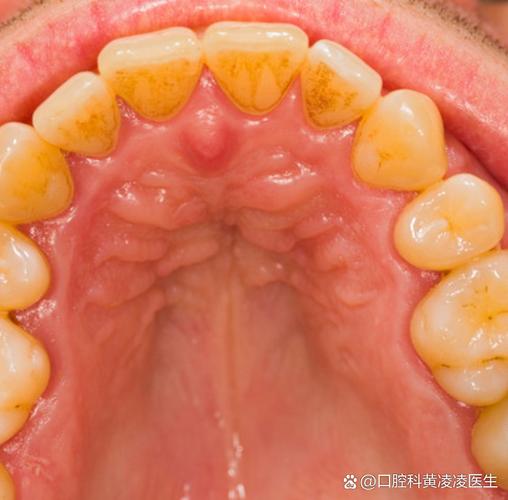 正畸牙龈周围充血是什么原因？-图1