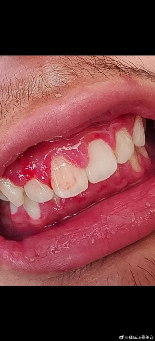 正畸牙龈周围充血是什么原因？-图3