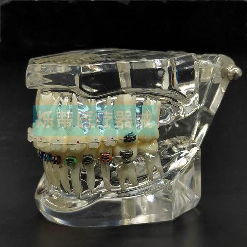 正畸陶瓷托槽优点何在？美观与舒适度如何兼顾？-图2