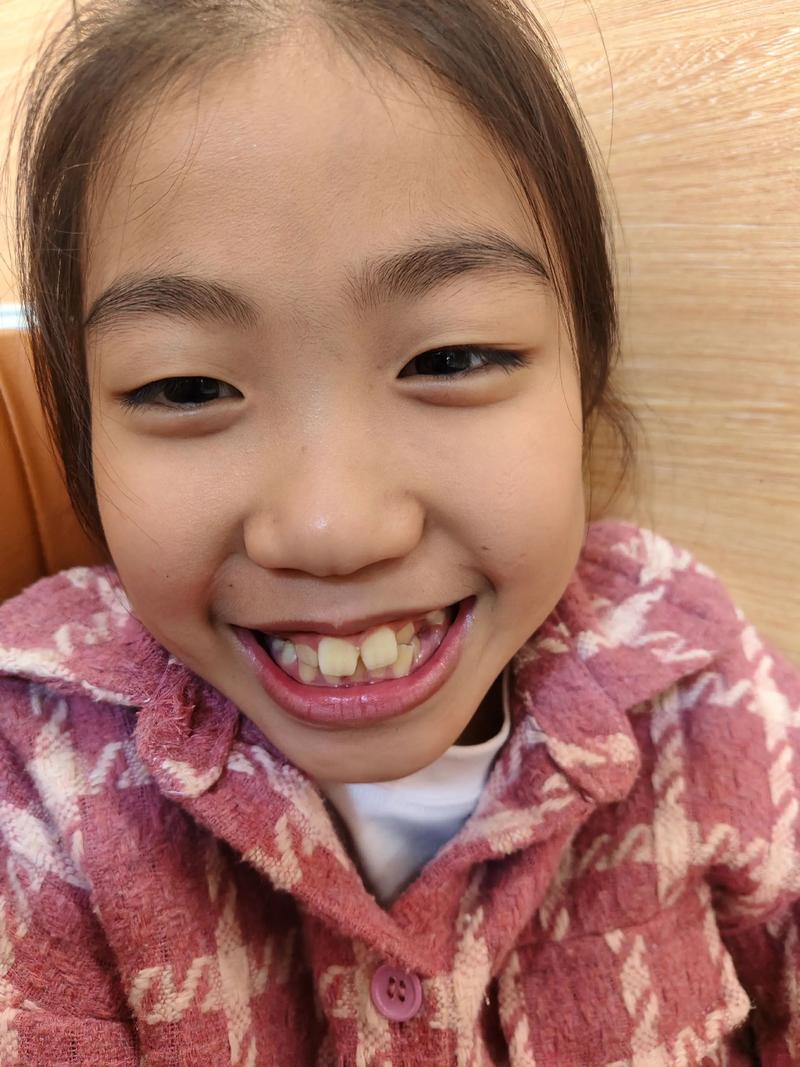 正畸帽子挂钩变直了，是什么原因导致的？-图1