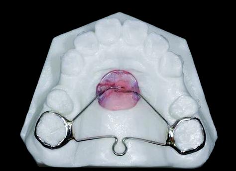 正畸关闭间隙材料-图2