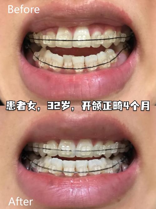 正畸打开咬合图片-图1