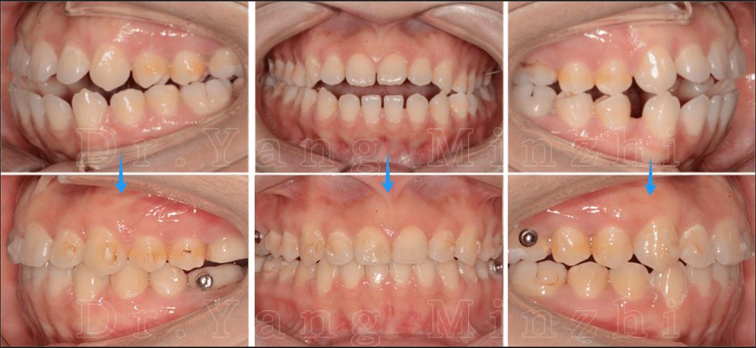正畸打开咬合图片-图2