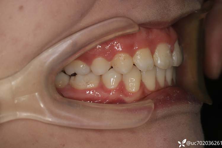 正畸咬合平面倾斜-图2 正畸咬合平面倾斜-图2