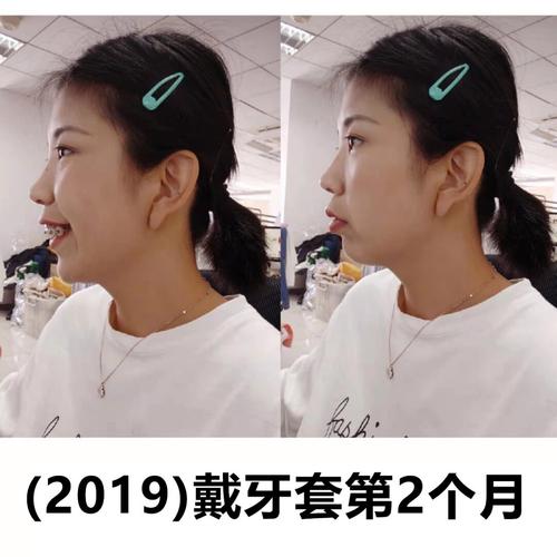 杭州龅牙快速正畸效果如何？矫正周期多久？-图3