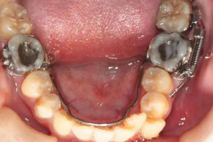 正畸 推磨牙向前-图1 正畸 推磨牙向前-图1