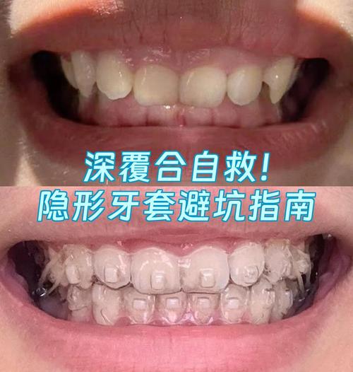 隐形正畸真的没用？这些原因让矫正白做了！-图2