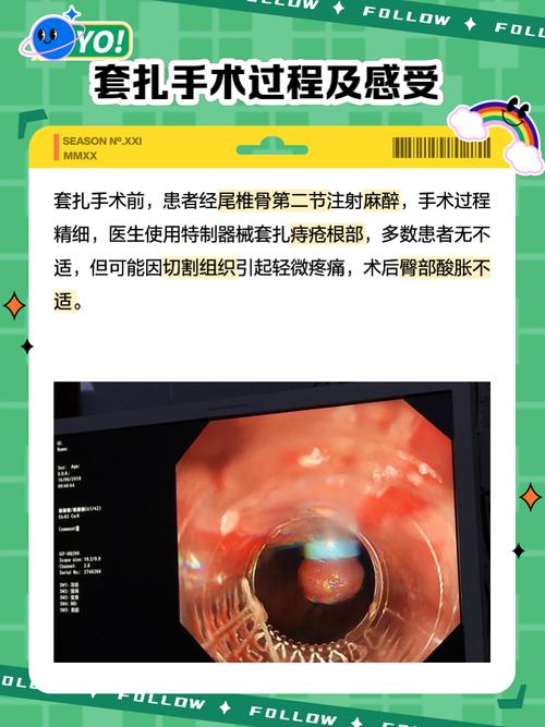 正畸连续结扎方法-图1