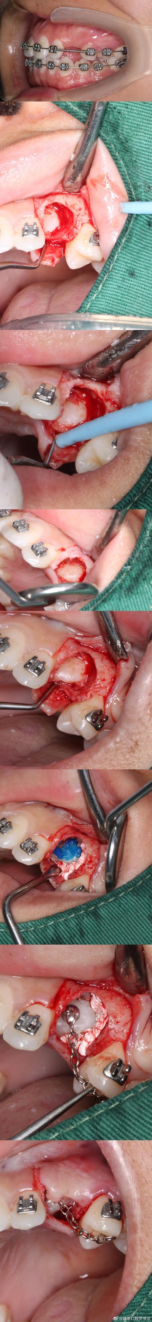 日本LH正畸技术是什么?效果和优势如何?-图1 日本LH正畸技术是什么?效果和优势如何?-图1