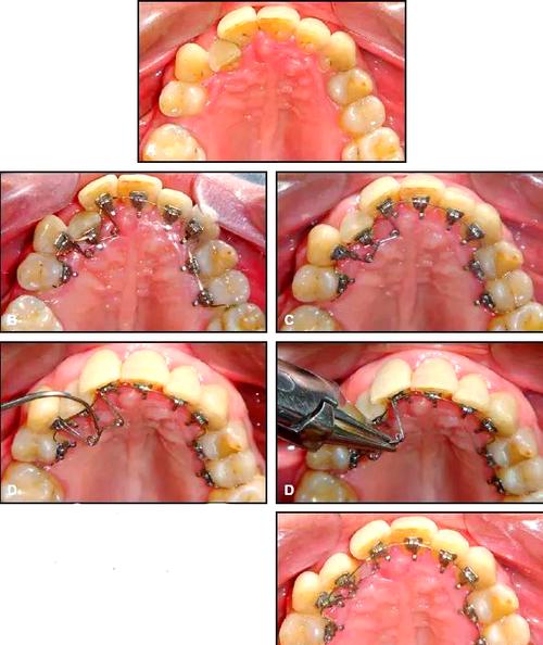 日本LH正畸技术是什么?效果和优势如何?-图3 日本LH正畸技术是什么?效果和优势如何?-图3