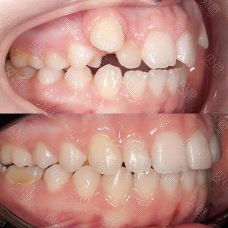 虎牙缺失正畸能恢复吗?前后变化大吗?-图1 虎牙缺失正畸能恢复吗?前后变化大吗?-图1