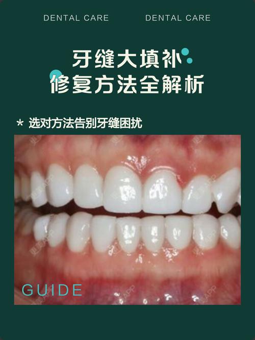 正畸怎么修复牙缝-图3