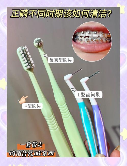 正畸期间怎么清洁-图2