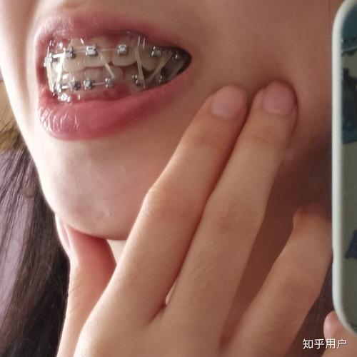 正畸戴皮筋效果真的好吗？一般戴多久才能看到改善？-图1