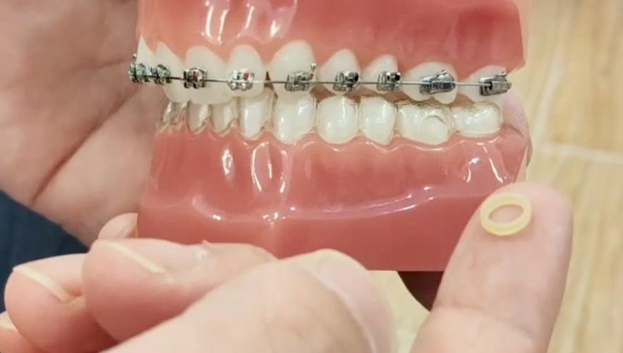 正畸戴皮筋效果真的好吗？一般戴多久才能看到改善？-图2