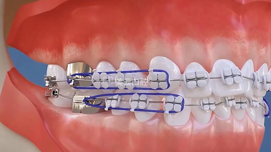 正畸托槽放置位置-图2
