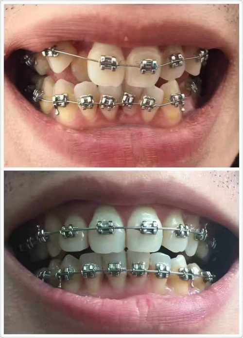 正畸托槽放置位置-图3