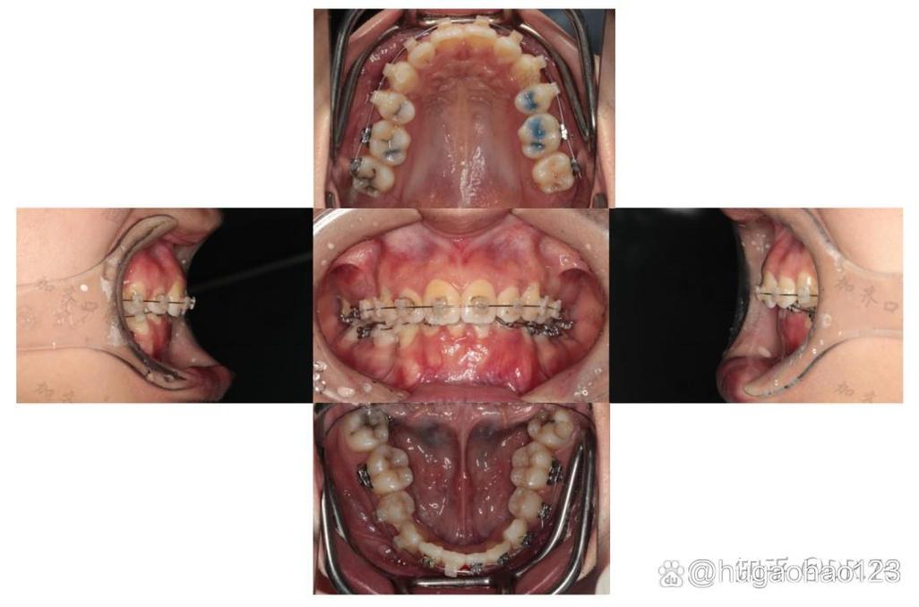 rw正畸失败案例-图1