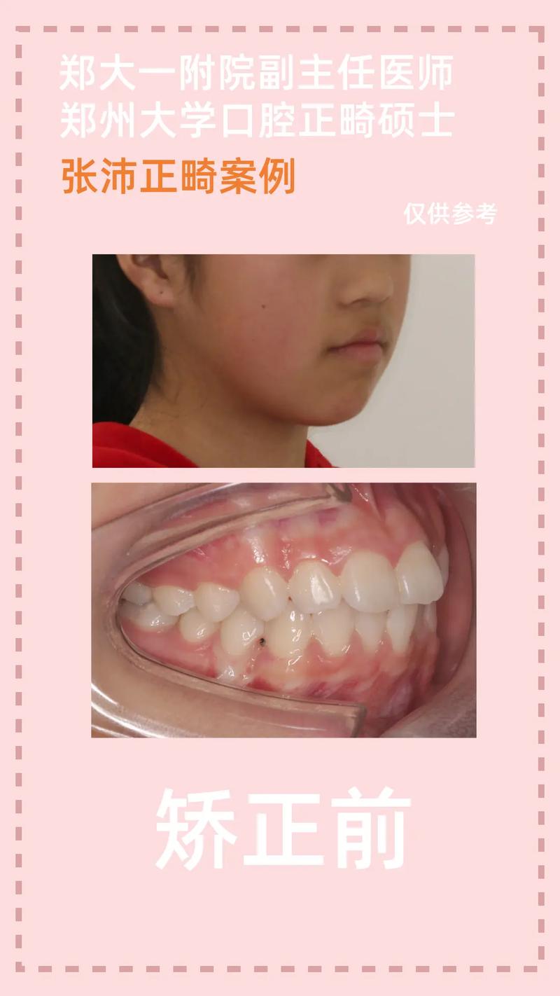 rw正畸失败案例-图3