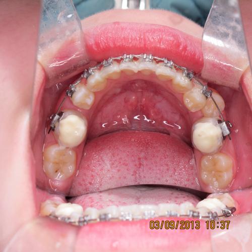 正畸牵引尖牙博客-图1 正畸牵引尖牙博客-图1