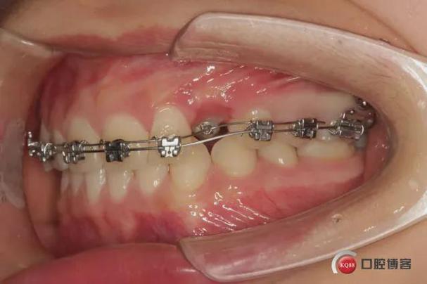 正畸牵引尖牙博客-图3 正畸牵引尖牙博客-图3