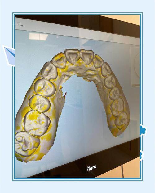 正畸模型测量视频-图1 正畸模型测量视频-图1